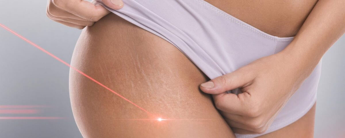 laser smagliature