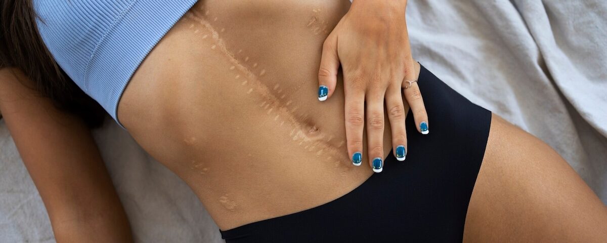 trattamento laser cicatrici