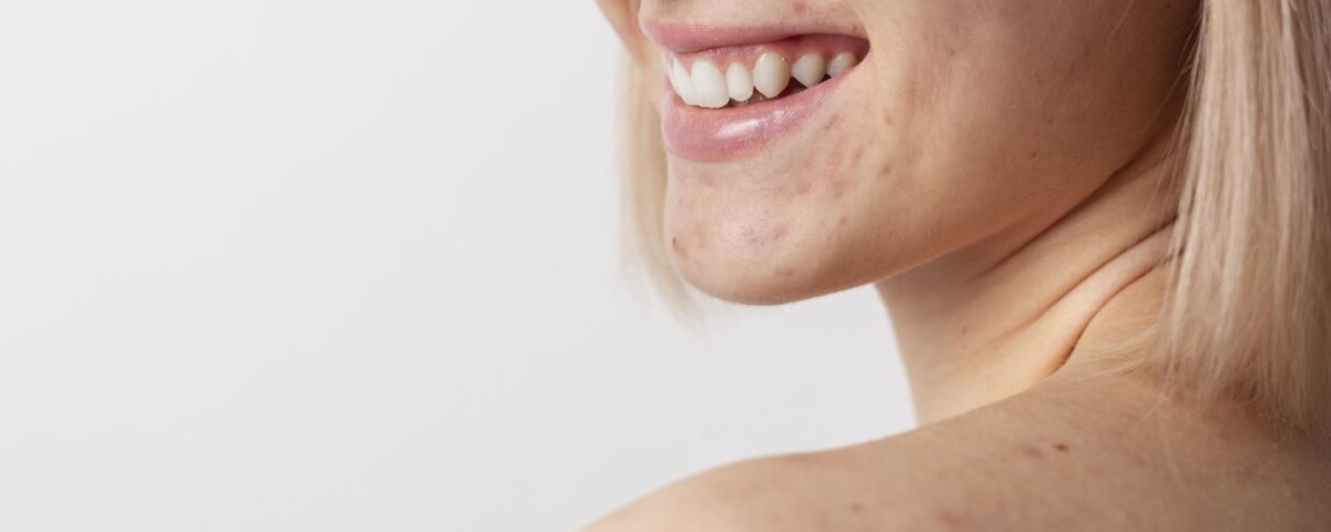 come migliorare la pelle con co2 frazionato