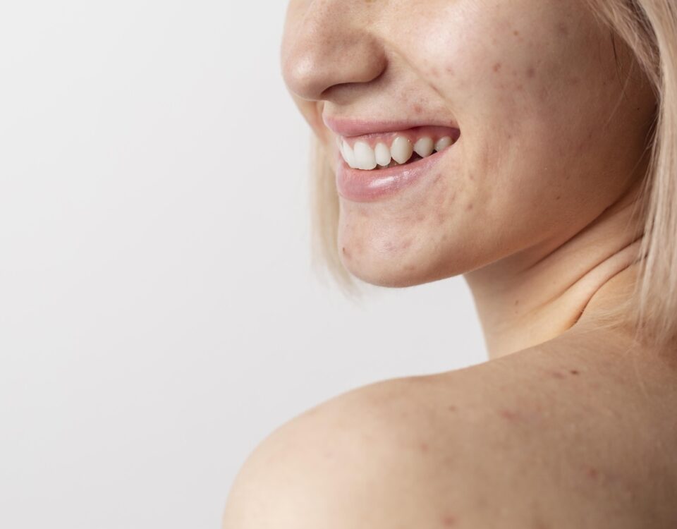 come migliorare la pelle con co2 frazionato